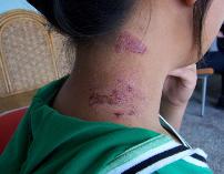  这是一个紫外线皮炎患者衣服遮盖的地方没有皮疹，暴露的皮肤就会出现
