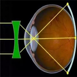 誉康视光视力保健视线