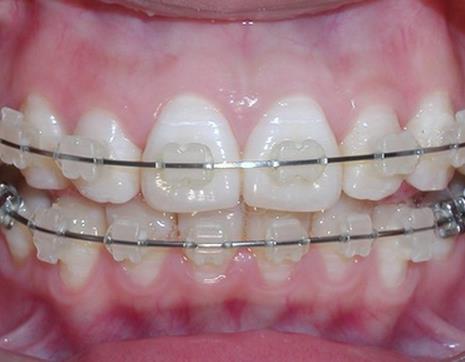 雅典口腔国际型牙科门诊箍牙