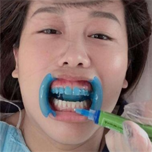 冰瓷美牙洗牙