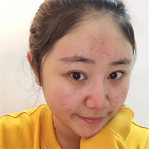  Acne clearing and acne removing without acupuncture